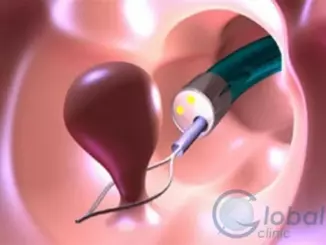 Что такое полип эндометрия?